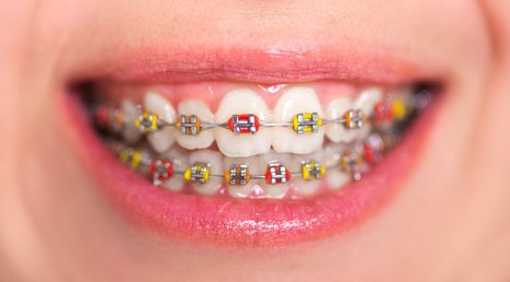 Feste Zahnspange mit bunten Gummiligaturen [©Kirill Grekov, Fotolia]