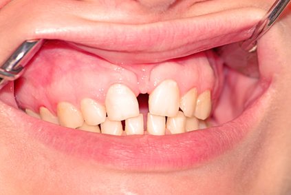 Diastema mediale im Oberkiefer [©DrTI, Fotolia]